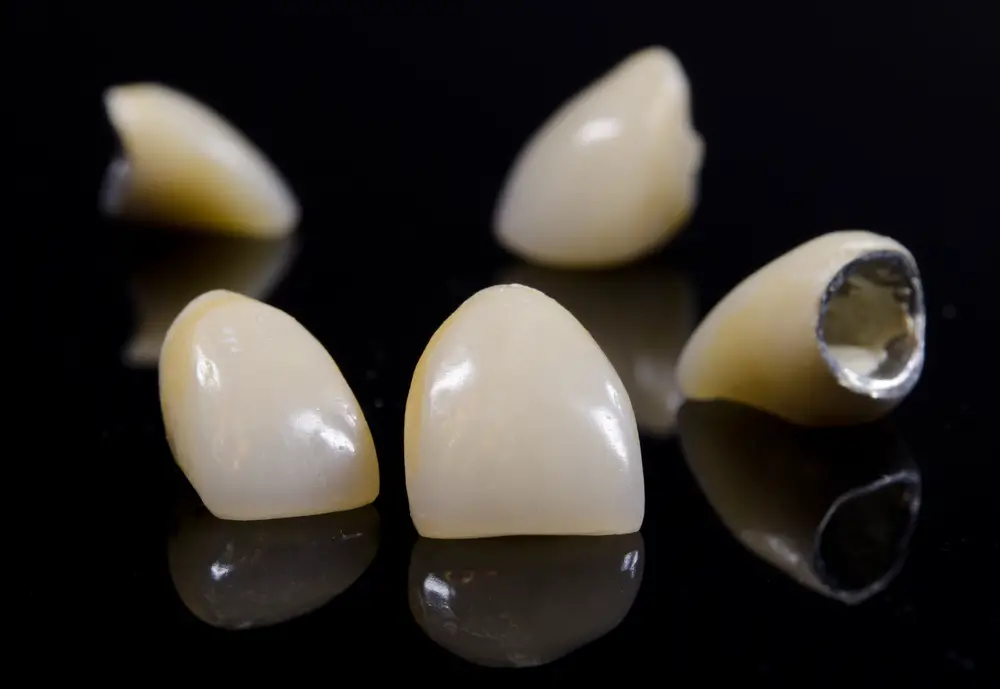 Are Teeth Caps Glued On? All You Need to Know
