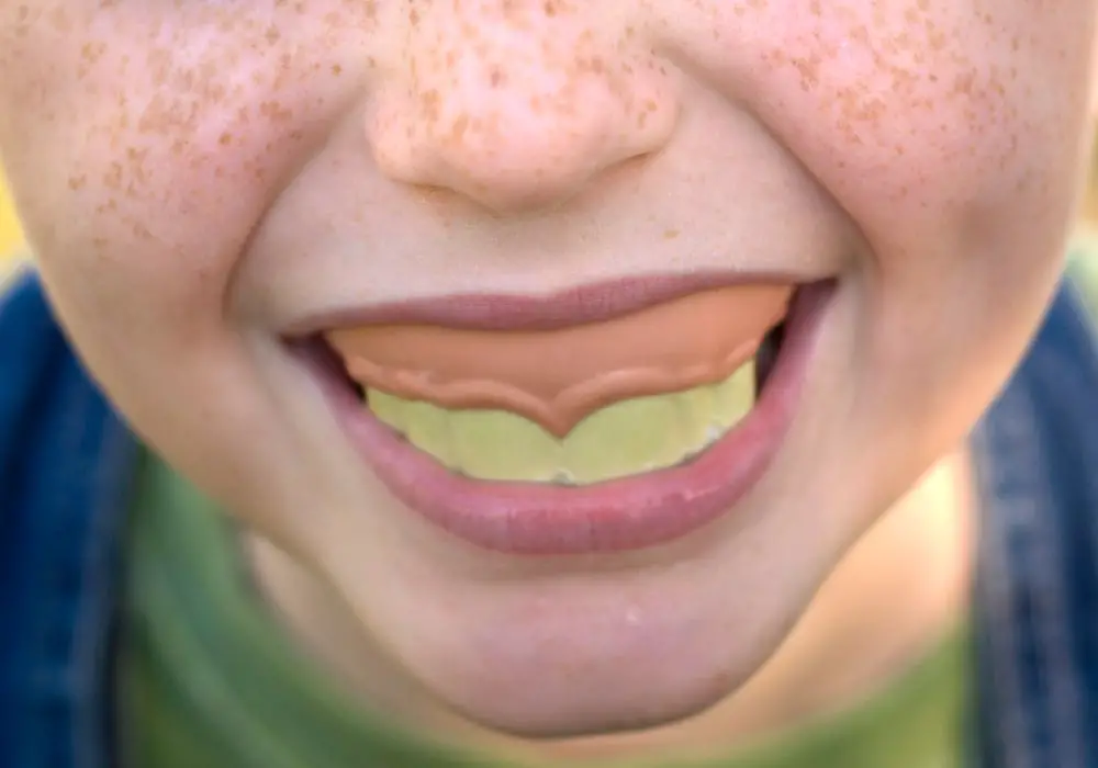 Buck Teeth in Children