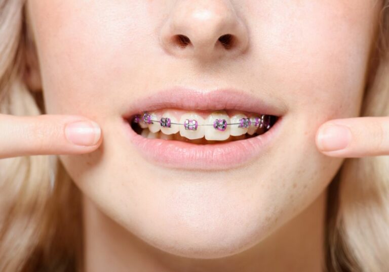 Can I Get Braces Even If My Teeth Are Straight? (Exploring Orthodontic Options for Aesthetic Improvement)