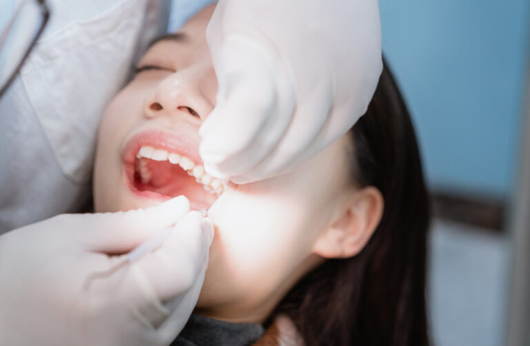 48 Hours After Wisdom Teeth Removal: Is It Safe to Brush Your Teeth?