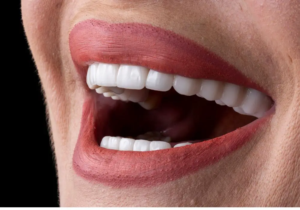 Can You Straighten Crooked Teeth with Veneers? Exploring Your Options