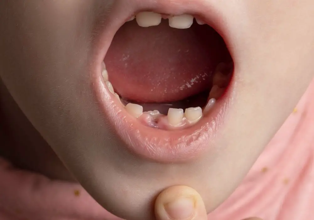 Common Problems with Milk Teeth