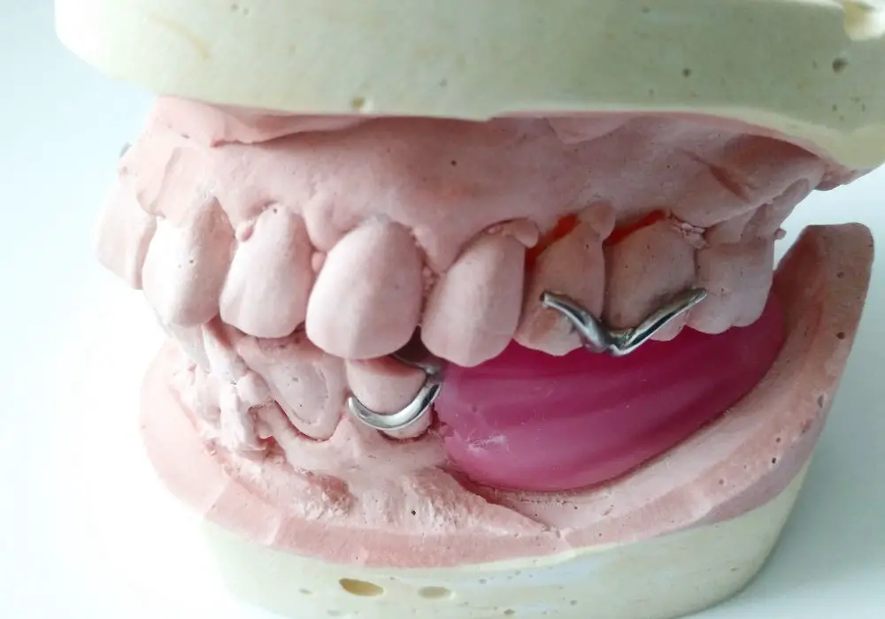 Dental Bridge