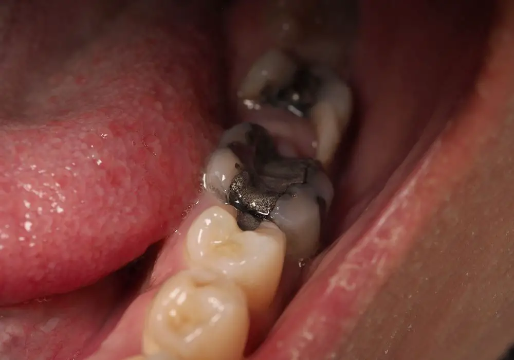 Diagnosis of Black Teeth