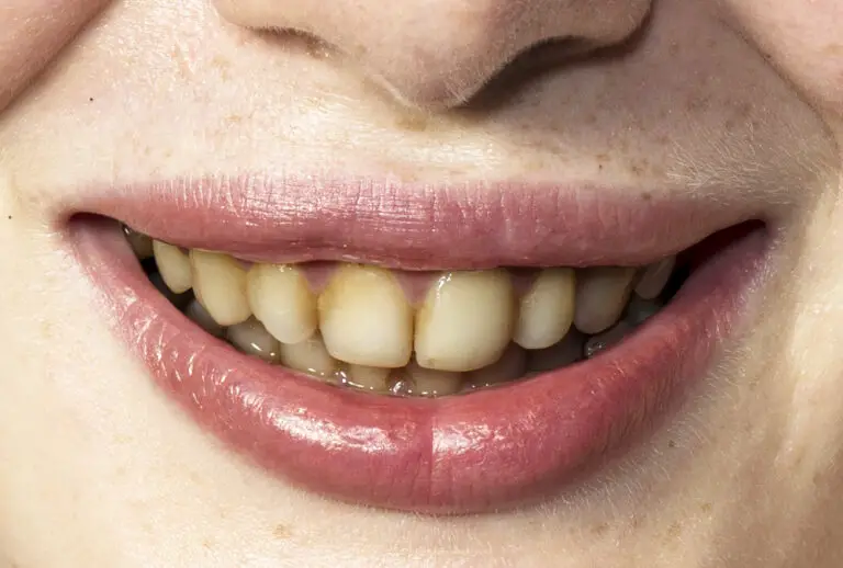 Do Yellow Teeth Age You? The Truth About Teeth Discoloration and Aging