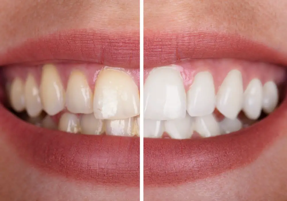 Free Teeth Whitening in How to Do It Yourself