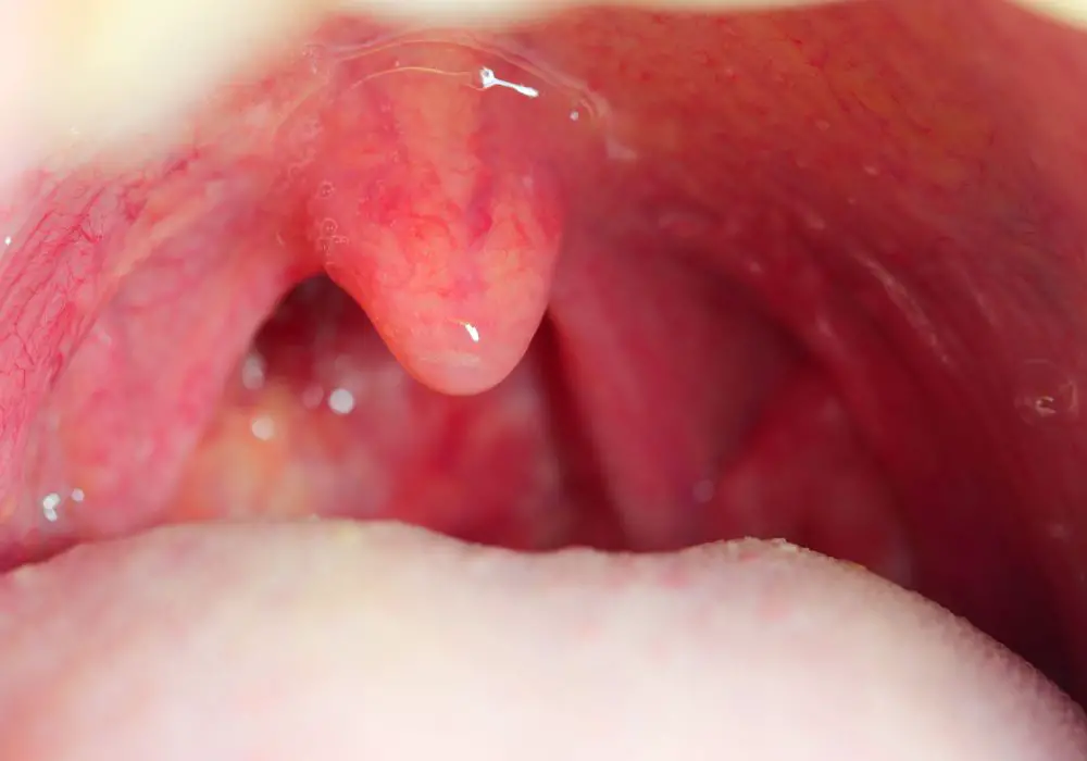 How Poor Oral Hygiene Leads to Throat Infections