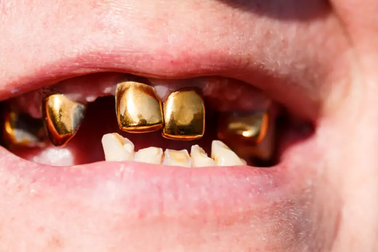 How a Gold Tooth is Made: A Brief Overview