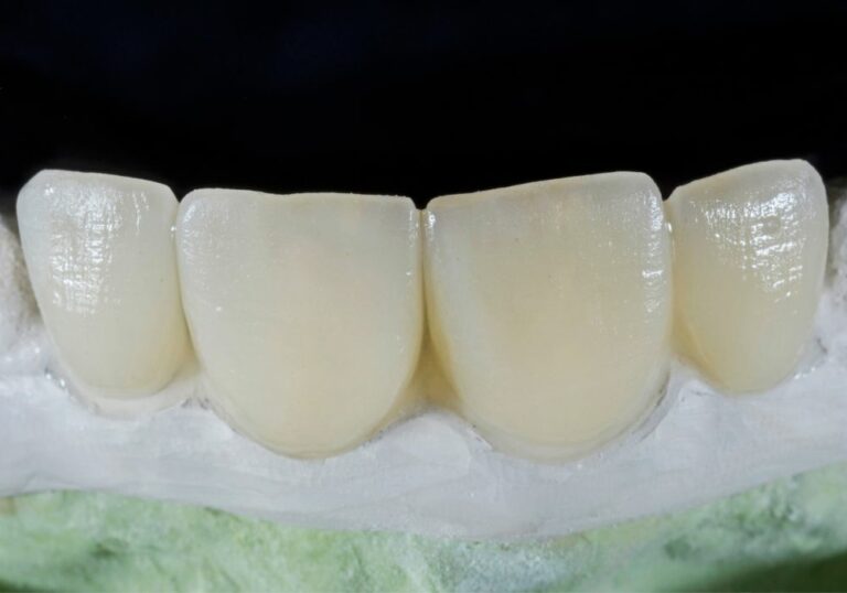 Covering Missing Teeth: Tips While Waiting for Implant