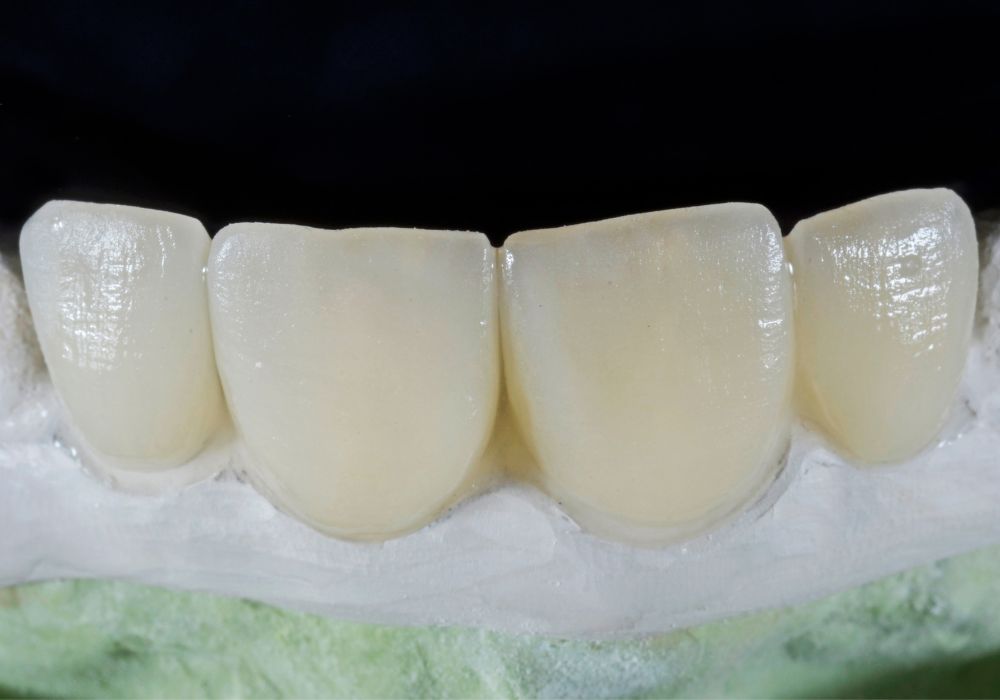 Covering Missing Teeth Tips While Waiting for Implant