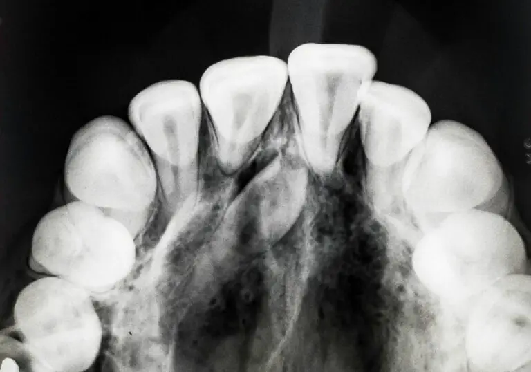 Is 34 Teeth Possible? Exploring the Science of Extra Teeth