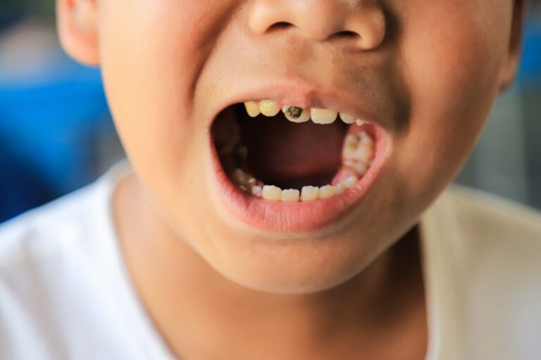 Is Tooth Erosion Serious? What You Need to Know