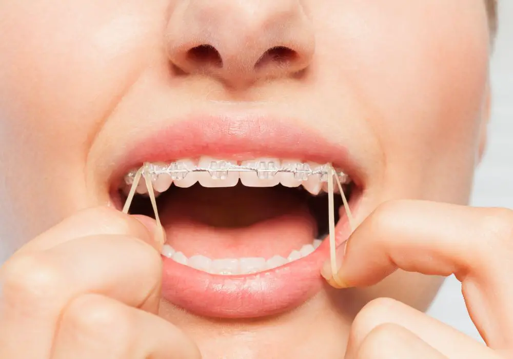 Orthodontic Treatment