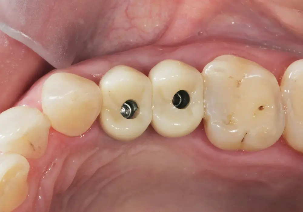Temporary Solutions for Missing Teeth
