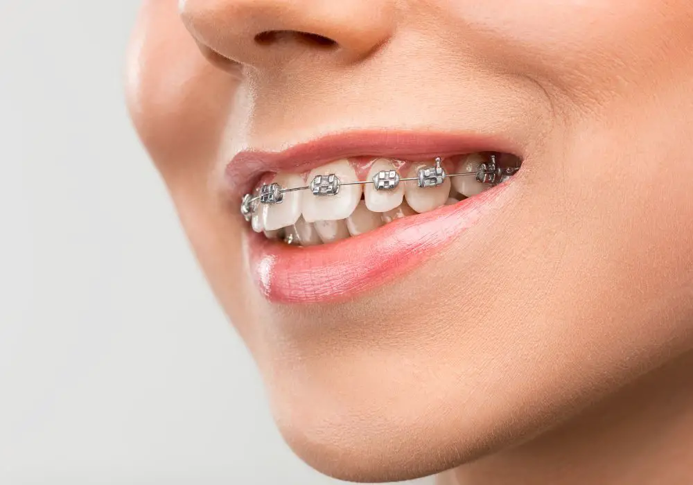 Types of Brackets and Their Impact on Tooth Movement