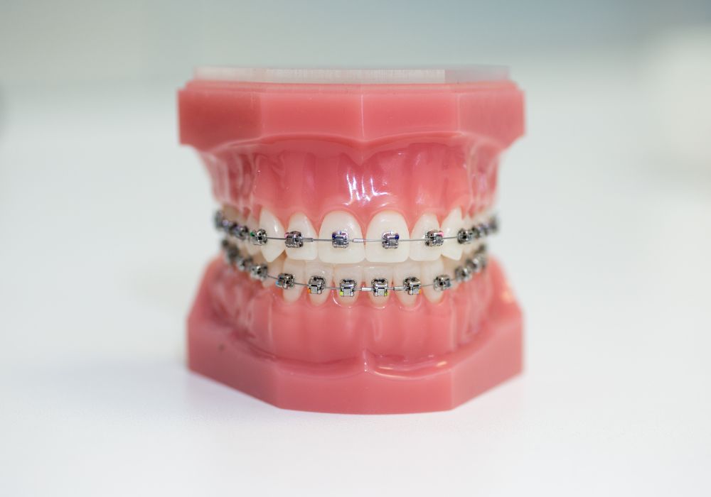 Understanding Brackets in Orthodontics