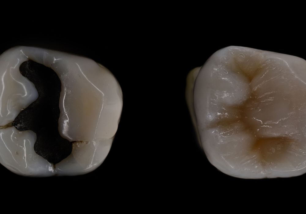 Understanding Composite Teeth