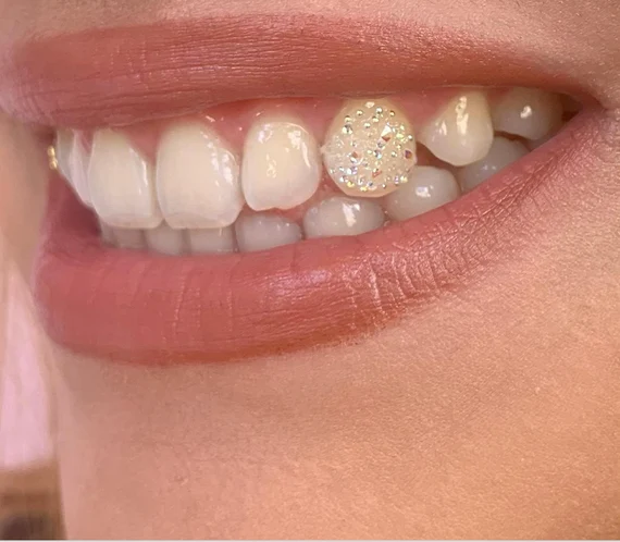 Understanding Tooth Gems