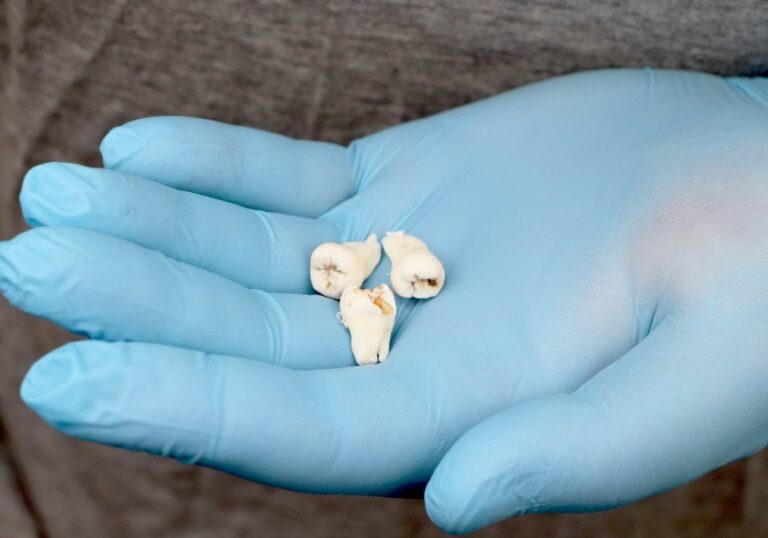 When to Stop Using Gauze After Wisdom Teeth Removal A Quick Guide