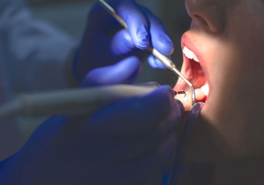 Understanding Wisdom Teeth Removal