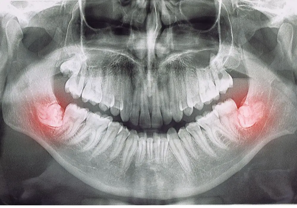 Understanding Wisdom Teeth