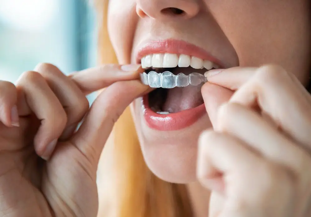 Understanding the Challenge of White Teeth with Braces