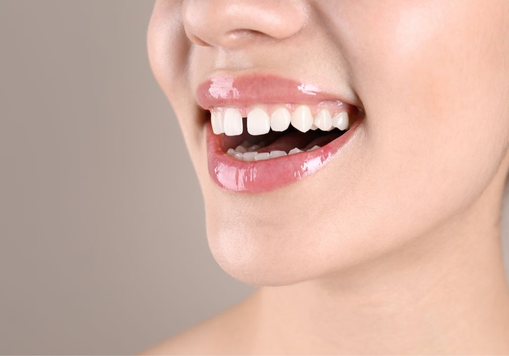 Understanding the Gap Between Teeth