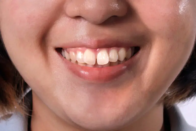 What Affects Teeth Shape? Understanding the Factors that Influence Your Smile