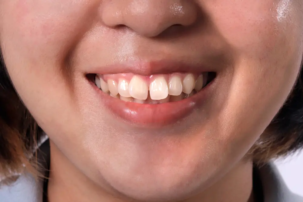 What Affects Teeth Shape? Understanding the Factors that Influence Your Smile