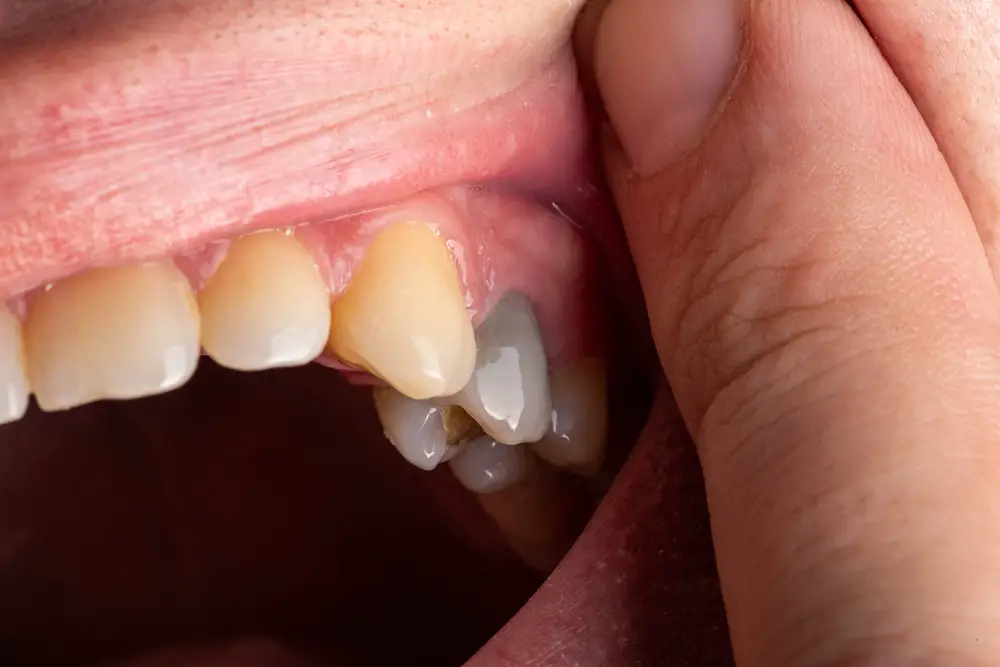 What Happens When Teeth Turn Black Causes And Treatment What Happens When Teeth Turn Black Causes And Treatment