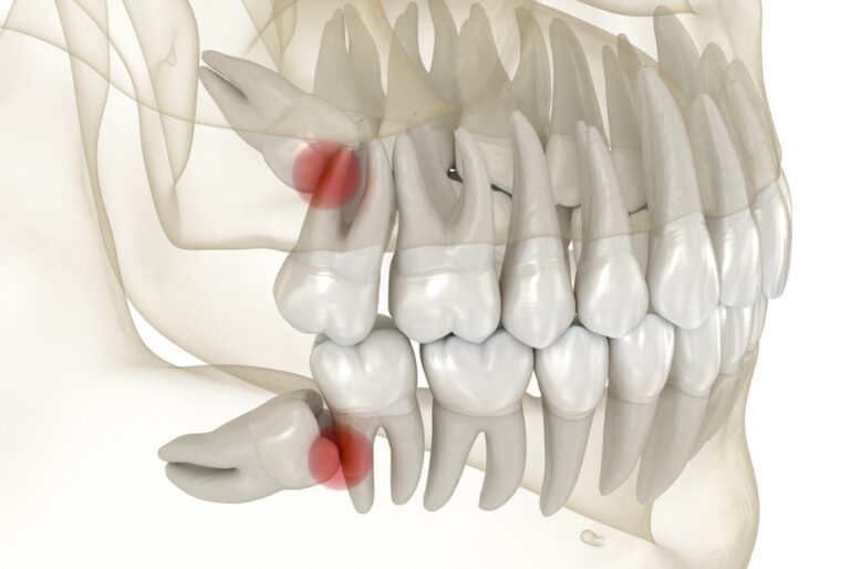 When Did Wisdom Teeth Emerge? A Brief Overview of Their Evolutionary History