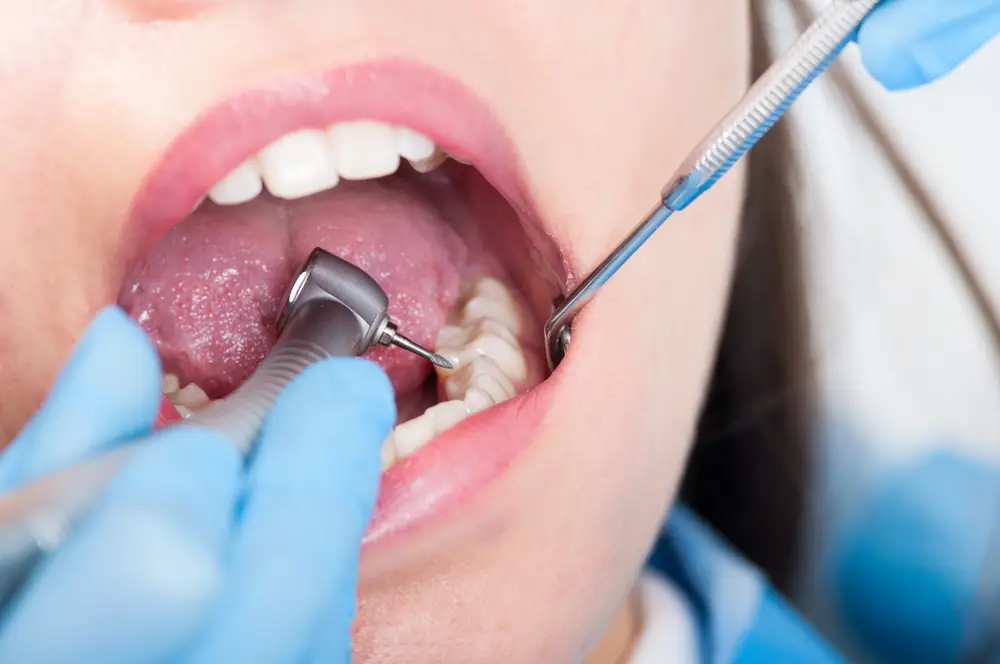 When to Drill a Tooth Factors to Consider
