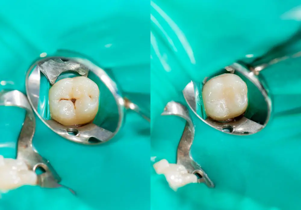 Who Should Consider Composite Teeth