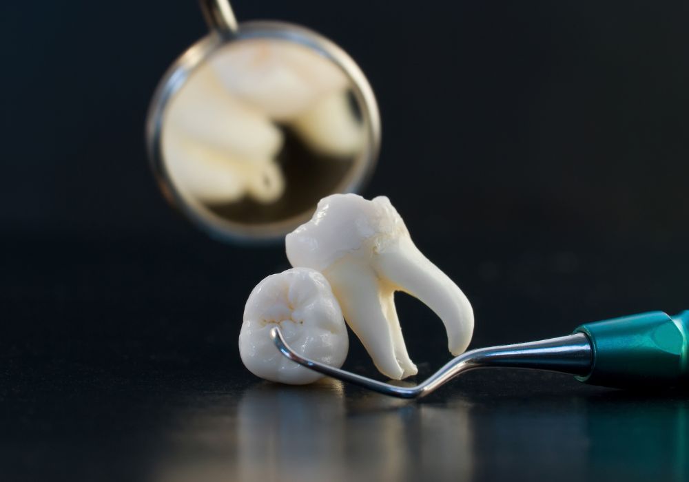 Why Wisdom Teeth Are Removed