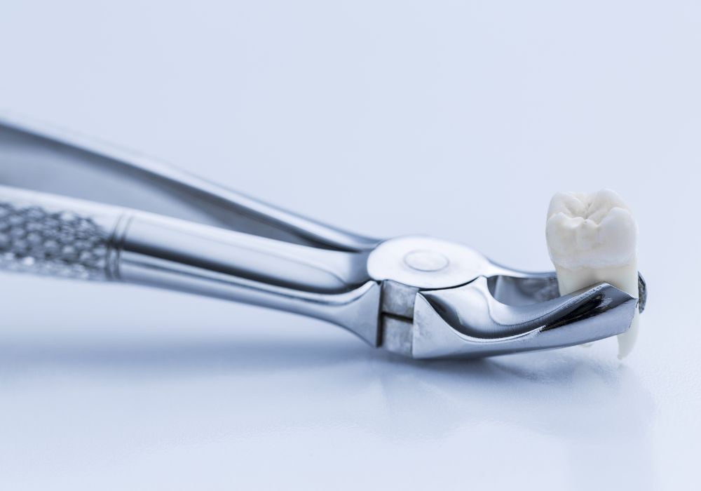 Why Wisdom Teeth are Removed