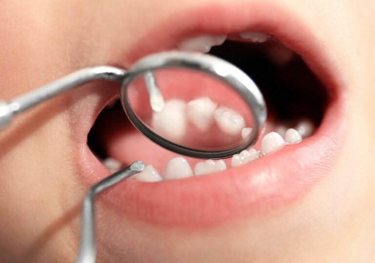 Can a Dentist Fill a Cavity in Between Two Teeth? Expert Answers