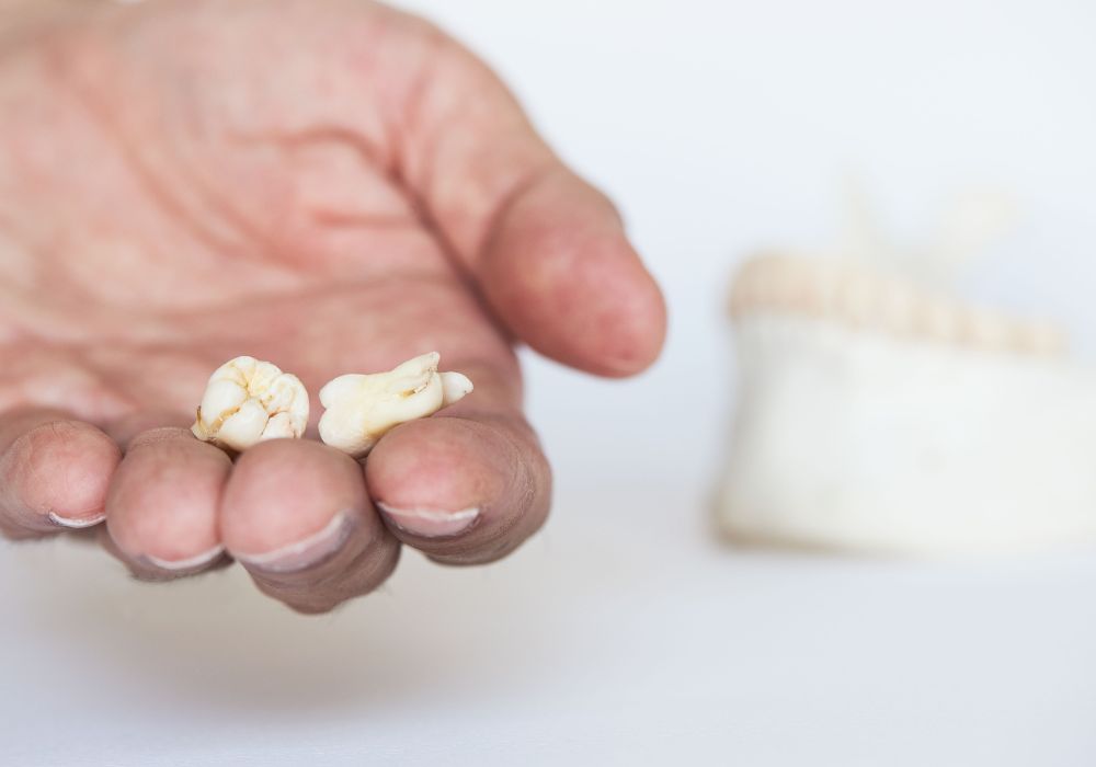 third molars