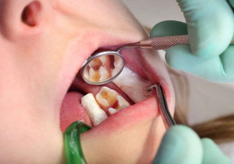 What Happens When a Cavity is in Between Two Teeth? Explained