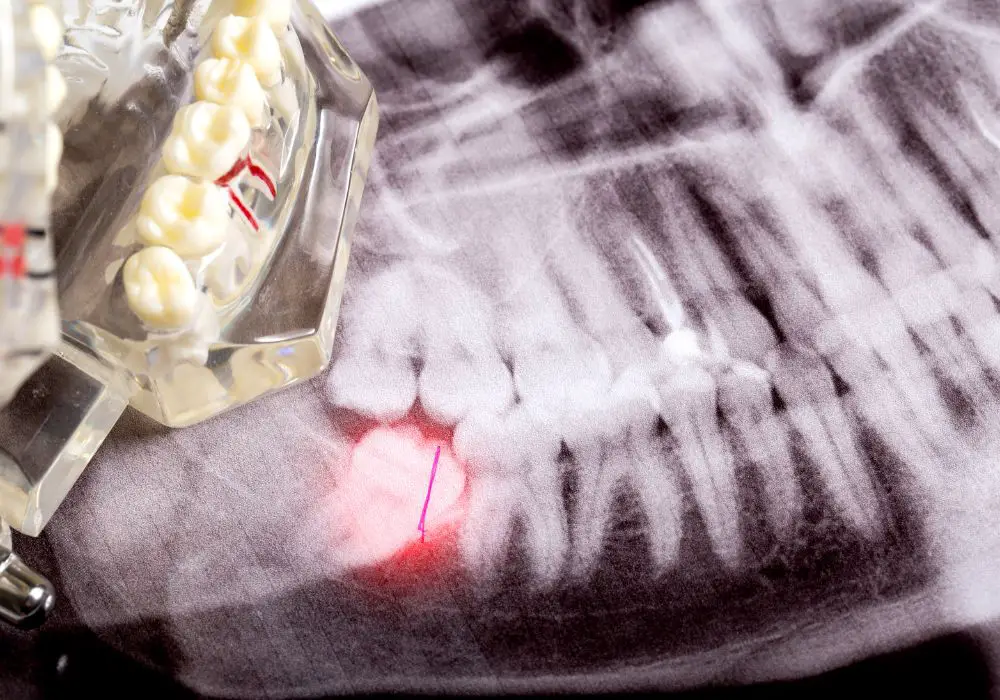 Identification of Impacted Wisdom Teeth