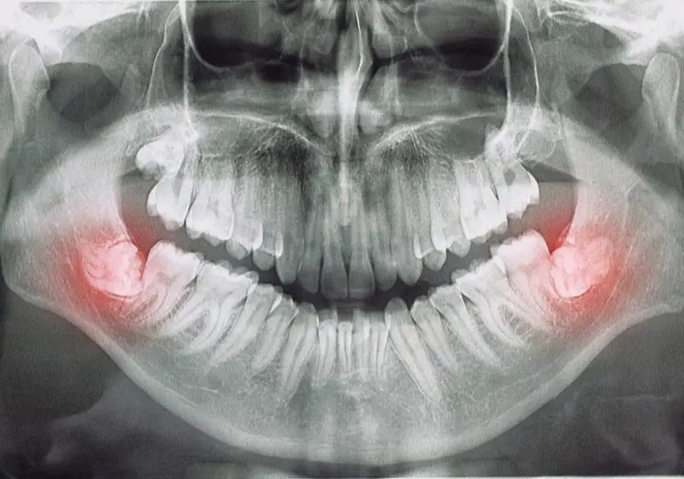 6 Signs of Impacted Wisdom Teeth