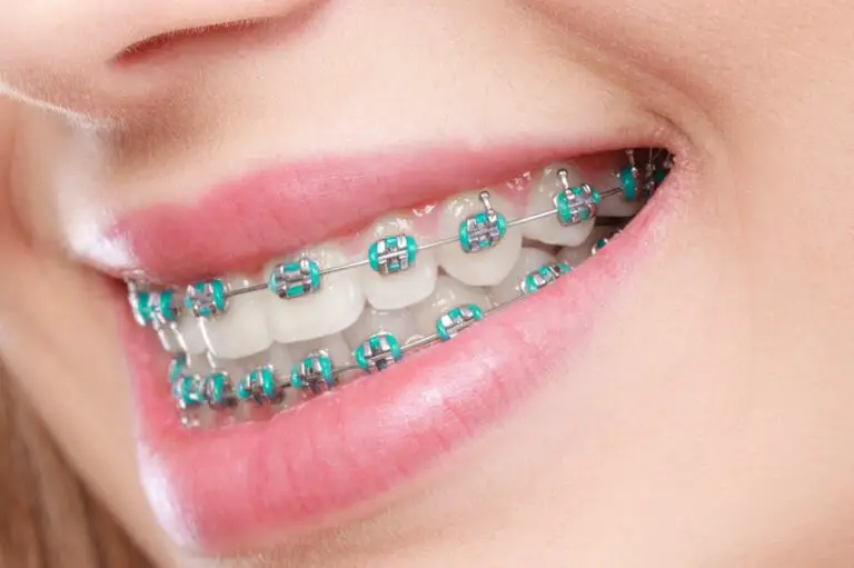 What To Expect During A Braces Consultation 