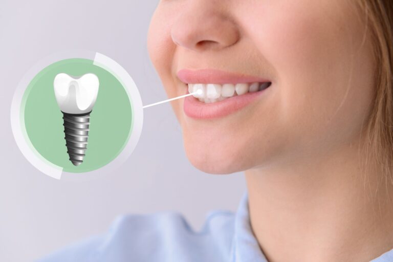 How Long Do Teeth Implants Last?